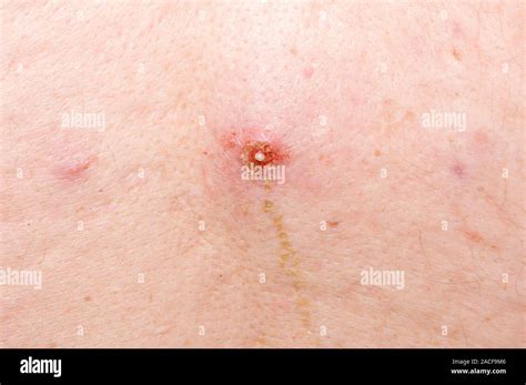 Infected Sebaceous Cyst Centre On The Back Of A Year Old Man