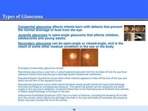 Ppt Glaucoma Information Powerpoint Presentation Free Download Id1058