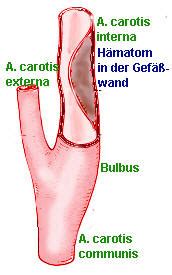 Dissektion Der Halsschlagadern