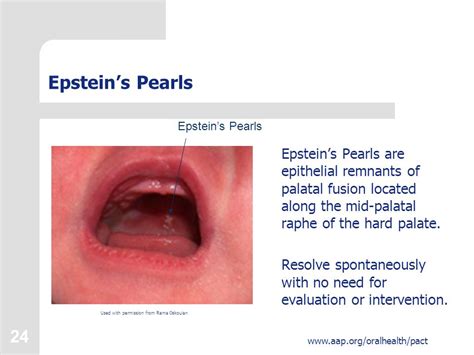 Epstein Pearls