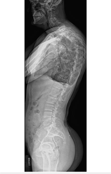 Lateral View Of Erect Thoracolumbar Scoliosis Series With Severe