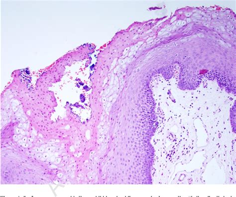 Figure 1 From Considerations In The Diagnosis Of Oral Hairy Leukoplakia