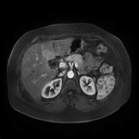 Acute Calcular Cholecystitis And Mirizzi Syndrome Image