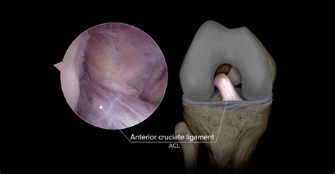 ACL Tear — Jonathan Koscso, MD