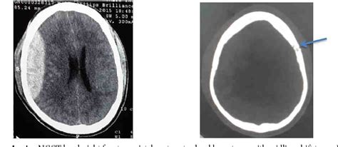 Figure 1 From Intraoperative Contralateral Extradural Hematoma During