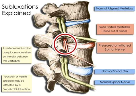 What is Subluxation? - Jenkins Family Chiropractic