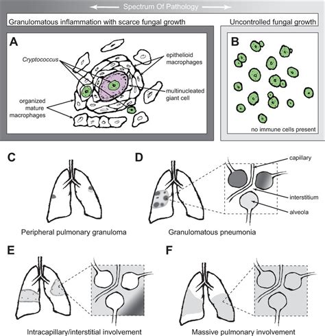 Pathological Types Of Pulmonary Cryptococcosis Panels A And B Download Scientific Diagram