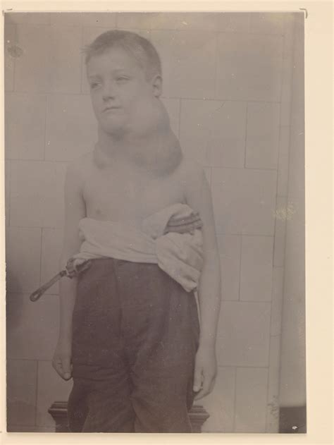 Boy with an extreme enlargement of the cervical glands | Wellcome