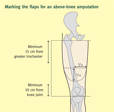 Amputation And Rehabilitation Surgery Oxford International Edition