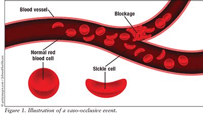 Sickle Cell Disease Pain Management