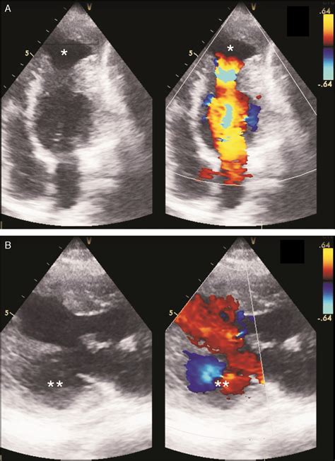 Transthoracic Two Dimensional Echocardiogram With Color Doppler A