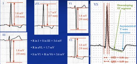 Ekg Exam Ventricular Hypertrophy Atrial Enlargement Electrolyte