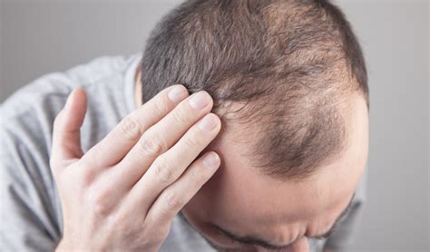 How Do Men Feel About Hair Loss Roc Private Clinic