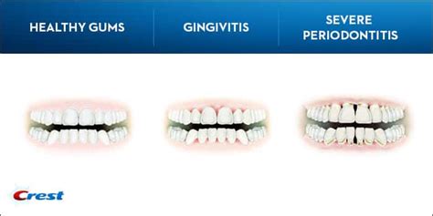 Symptoms of Periodontal Disease | Blog | Barry Levin DMD