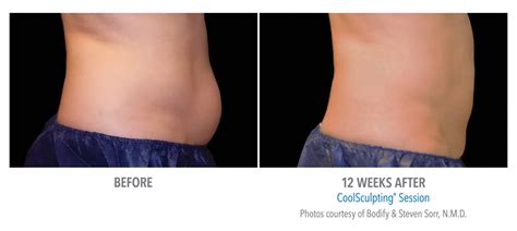 Coolsculpting Abdomen Stomach Before And After Photos Nyc