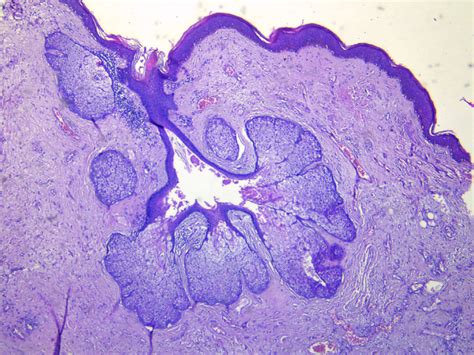 Rhinophyma Histology