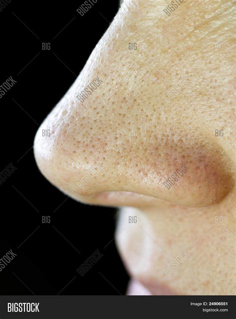 Nose Pores Blackheads Image & Photo (Free Trial) | Bigstock