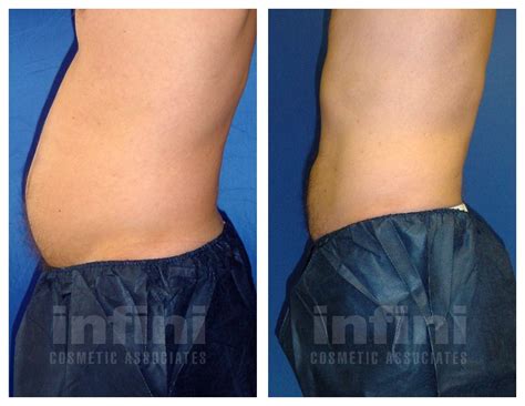 Male Liposuction Before And After Photos Stomach Phoenix Liposuction