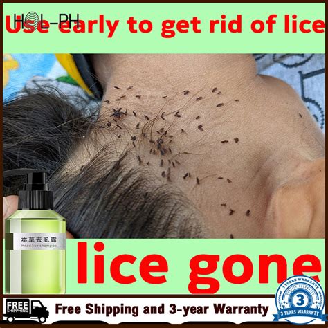 100ml Lice Remover Shampoo Licealiz Head Lice Treatment Shampoo