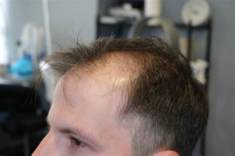 ~2500 Fue Hair Transplant By Dr Panine Chicago Hair Transplant Clinic Hair Transplant