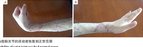 Figure 4 From Clinical Efficacy Of Vacuum Sealing Drainage And