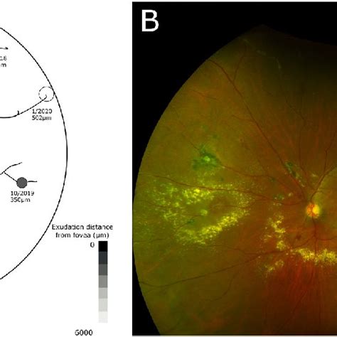 Each Macroaneurysm Is Labeled With Its Date And Diameter At Appearance