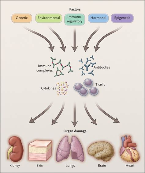 Systemic Lupus Erythematosus Nejm