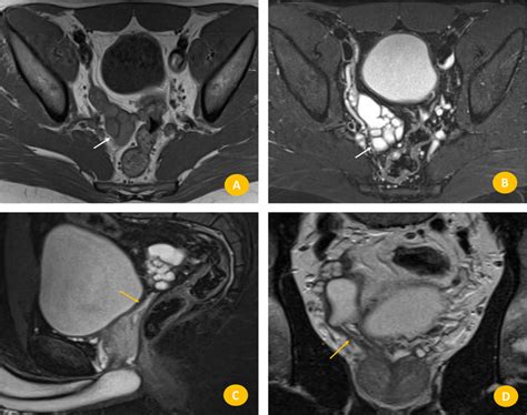 Pelvic Mri A And B Axial T1 And T2 Weighted Mri Image Showing Download Scientific Diagram