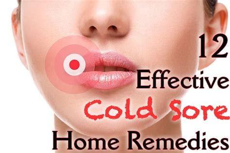 12 Effective Cold Sore Home Remedies Healthy Focus