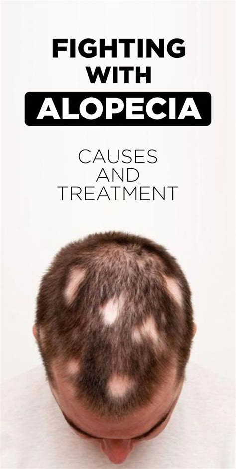 Causes And Treatment Of Alopecia Areata Artofit