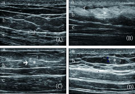 The Difference Between Normal Abdominal Subcutaneous Tissue And Lht