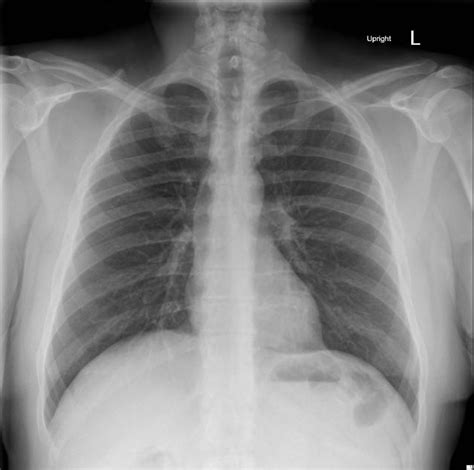 Normal CXR AP And Lateral JETem