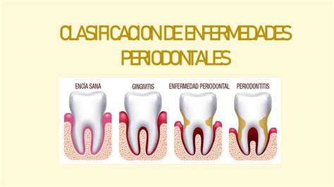 Clasificación de Enfermedades Periodontales Lizet Quezada uDocz