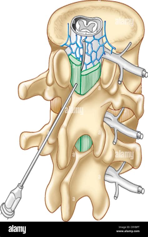 Epidural injections Fotos und Bildmaterial in hoher Auflösung Alamy