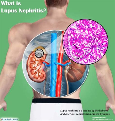 What Is Lupus Nephritis And How Is It Treated Lupus Nephritis Lupus Lupus Symptoms