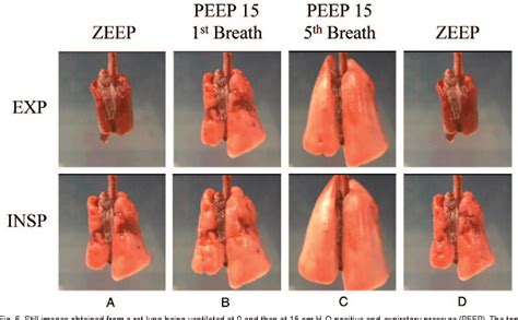 Figure 18 From Ventilator Induced Lung Injury From Barotrauma To