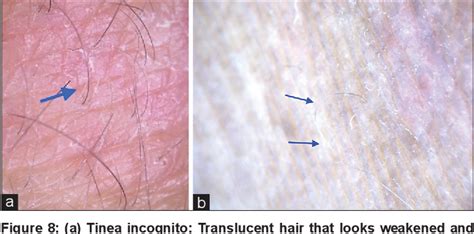 Figure From Can Dermoscopy Serve As A Diagnostic Tool In