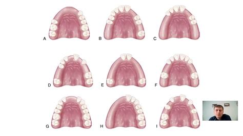 Kennedy Classification Of Dentition Defects And Applegate Rules How To Use Easy Youtube