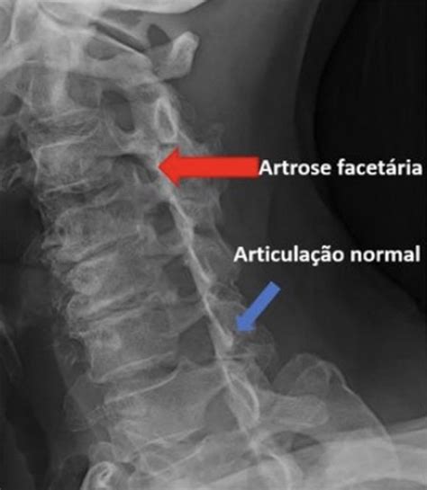 Artrose ou osteoartrite Núcleo de Ortopedia Especializada