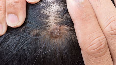 Pictures Of Sores And Scabs On Scalp Causes And More