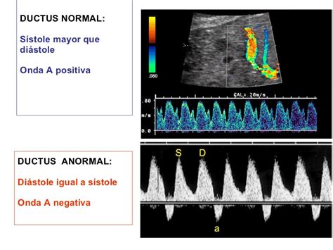 Ducto Venoso Onda A Positiva BRAINCP