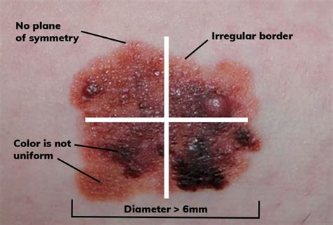 Identifying Mole vs. Melanoma: Critical Differences That Could Save ...