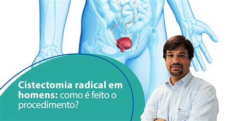 Cistectomia O Que É - Cistectomia Radical em homens: como é feito o procedimento? - Dr ...