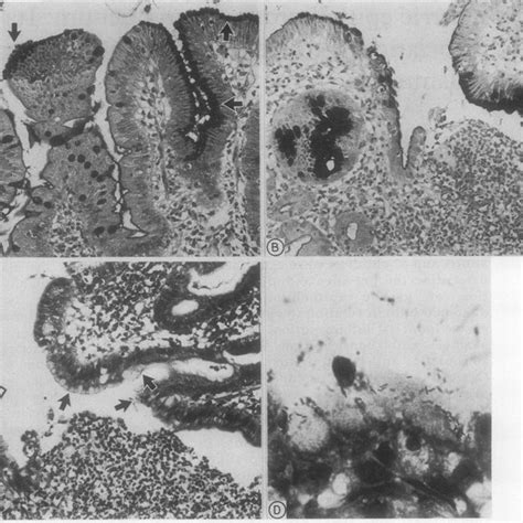 A Gastric Metaplasia Present In A Duodenal Biopsy Specimen Which Is