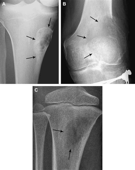 The Evolution Of Musculoskeletal Tumor Imaging Radiologic Clinics