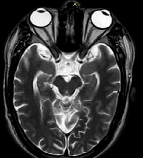 T2w Magnetic Resonance Axial Images Through The Level Of Optic Nerve