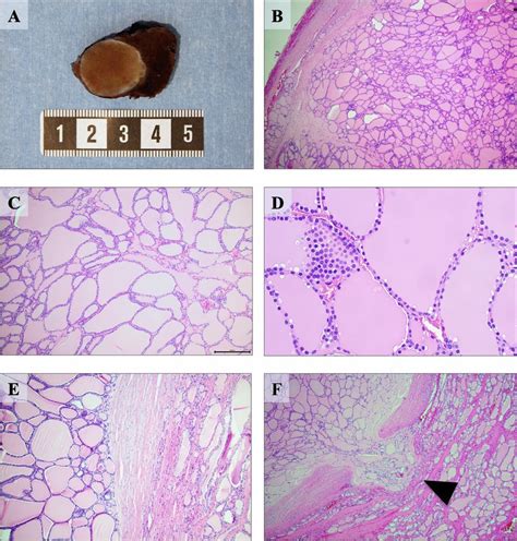 Macroscopic And Histological Attributes Of The Macrofollicular Variant