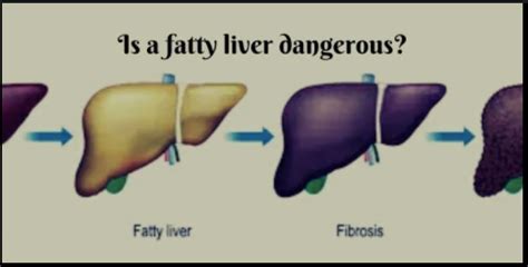 Hepatic Steatosis Prevention Risk Factors And Treatment By Vedayur