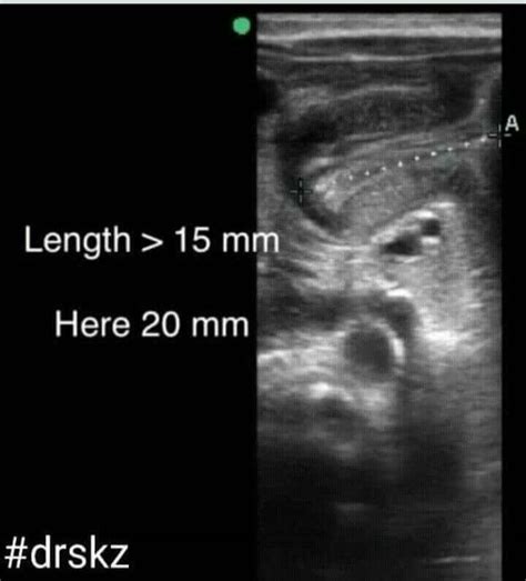 Diagnostic Criteria For Pyloric Stenosis Double Track Sign Single Muscle Thickness 3 Mm