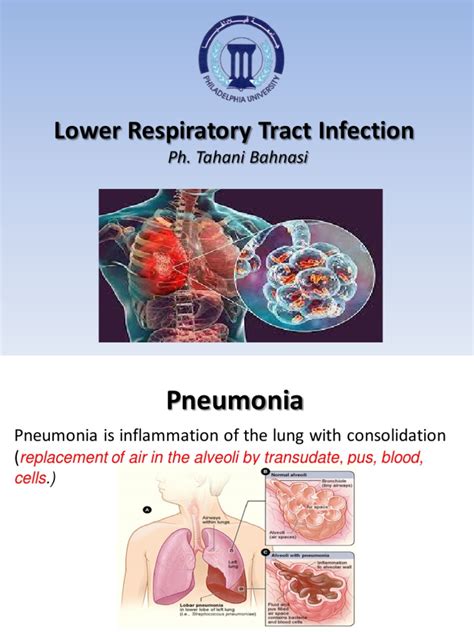 Lab 4 LRTI Part One | PDF | Pneumonia | Infection